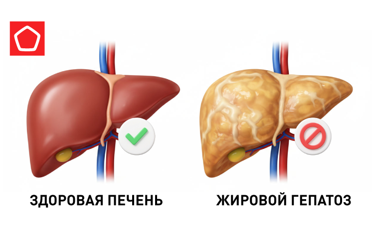 20903 ожирение печени_рисунок в статью 1 выбор.png