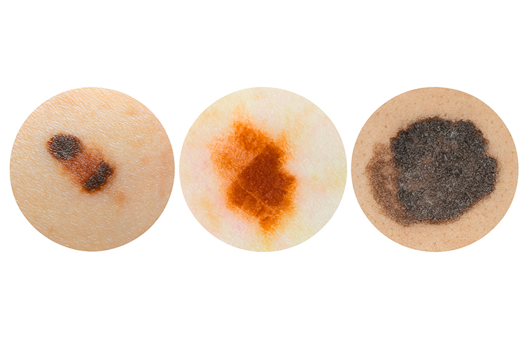 Примеры меланомы на коже Примеры меланомы на коже